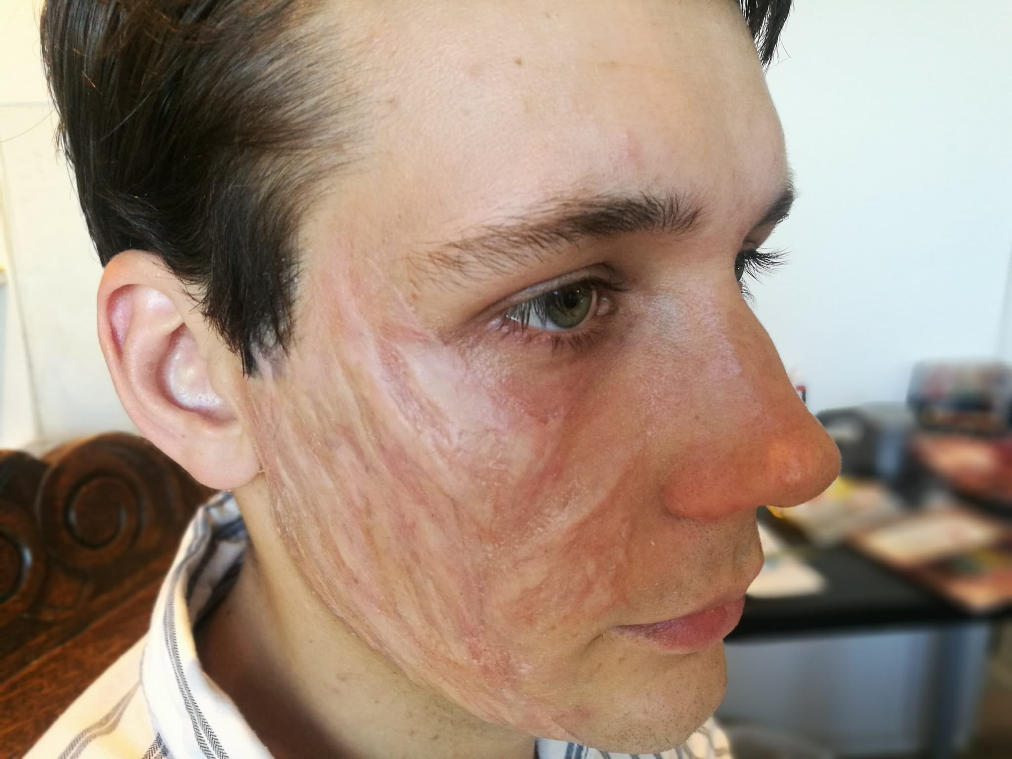 Burn Scar | MAD | Makeup Arts & Designs